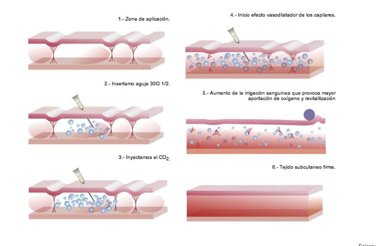 hidrolipoclasia efectos secundarios